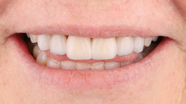 No-prep veneer case after — restored proportion and brightness, no enamel removed