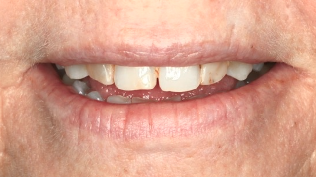 No-prep veneer case before — worn front teeth with shape irregularity