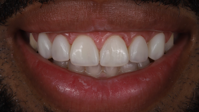 Veneer case after — proportional teeth, balanced smile line