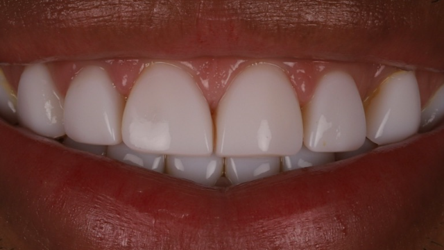 Veneer case before — small teeth, gummy display
