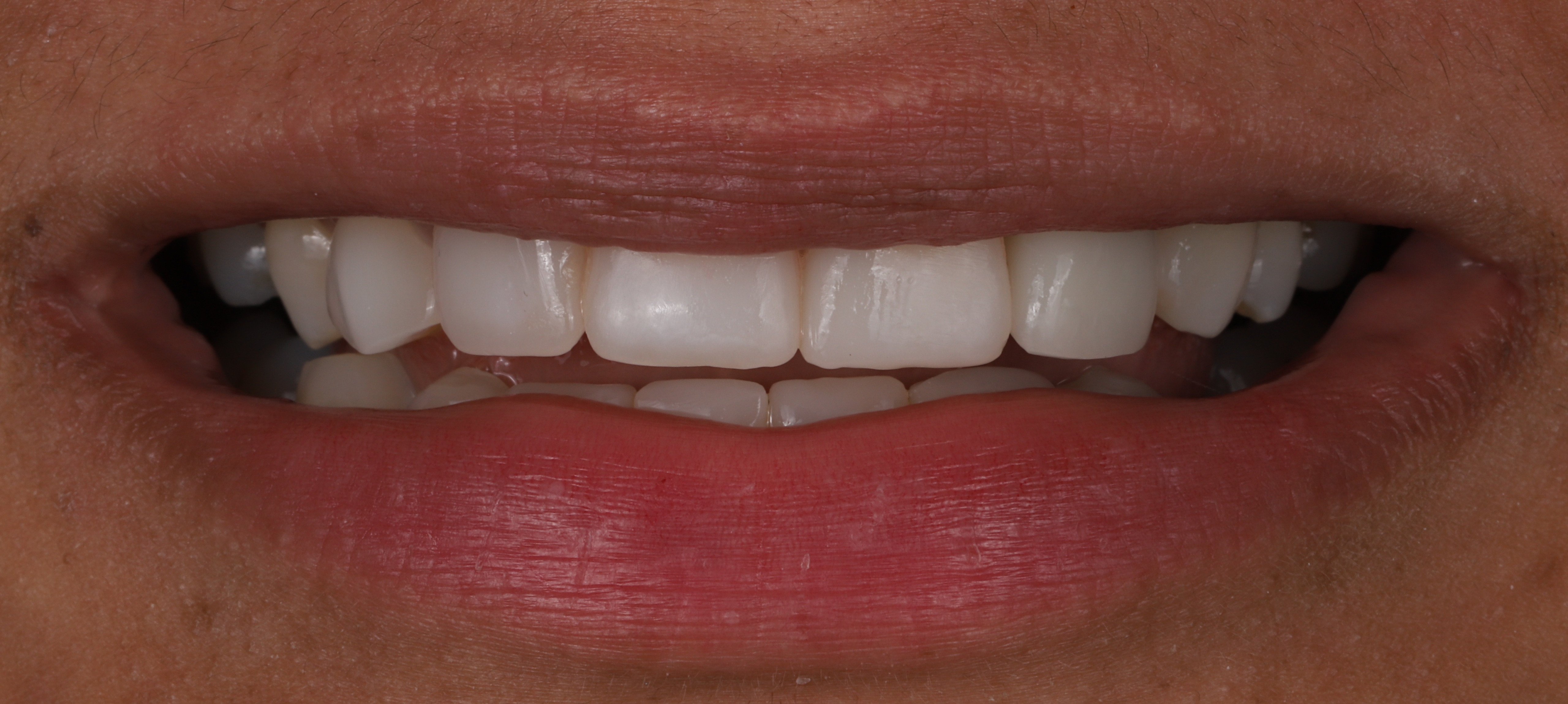 No-prep veneer case after — Radiant Dental patient