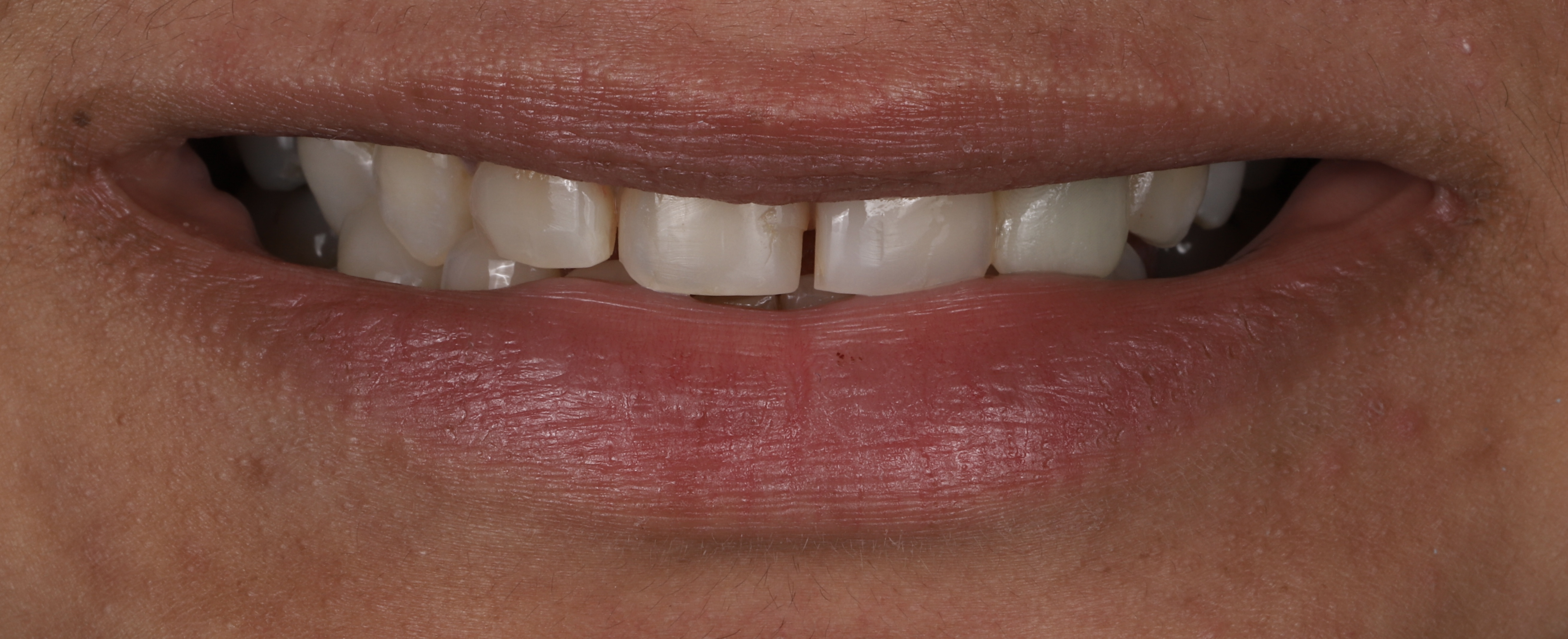 No-prep veneer case before — Radiant Dental patient